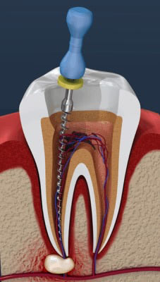 Root Canal Treatment Portland OR - Endodontics